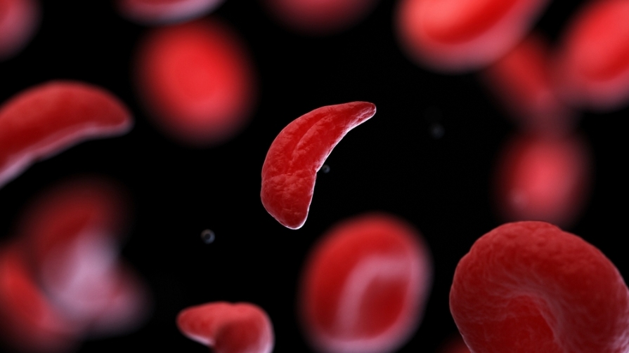 Sickle Shaped Red Blood Cell (Photo Courtesy: Bryant News)